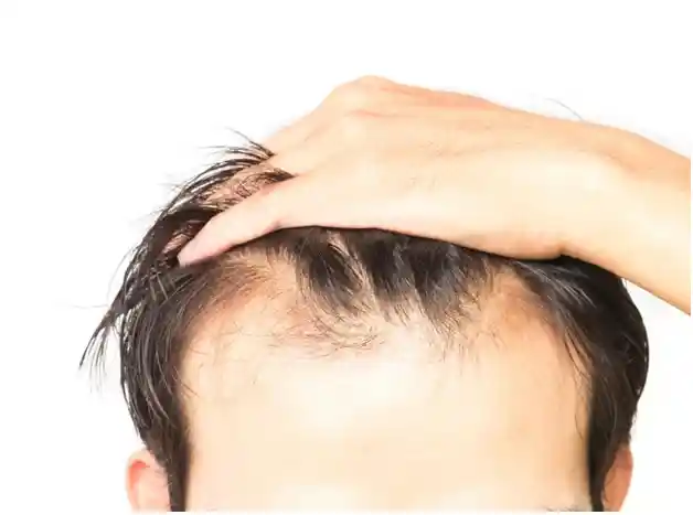 Tips to Prevent Hair Loss